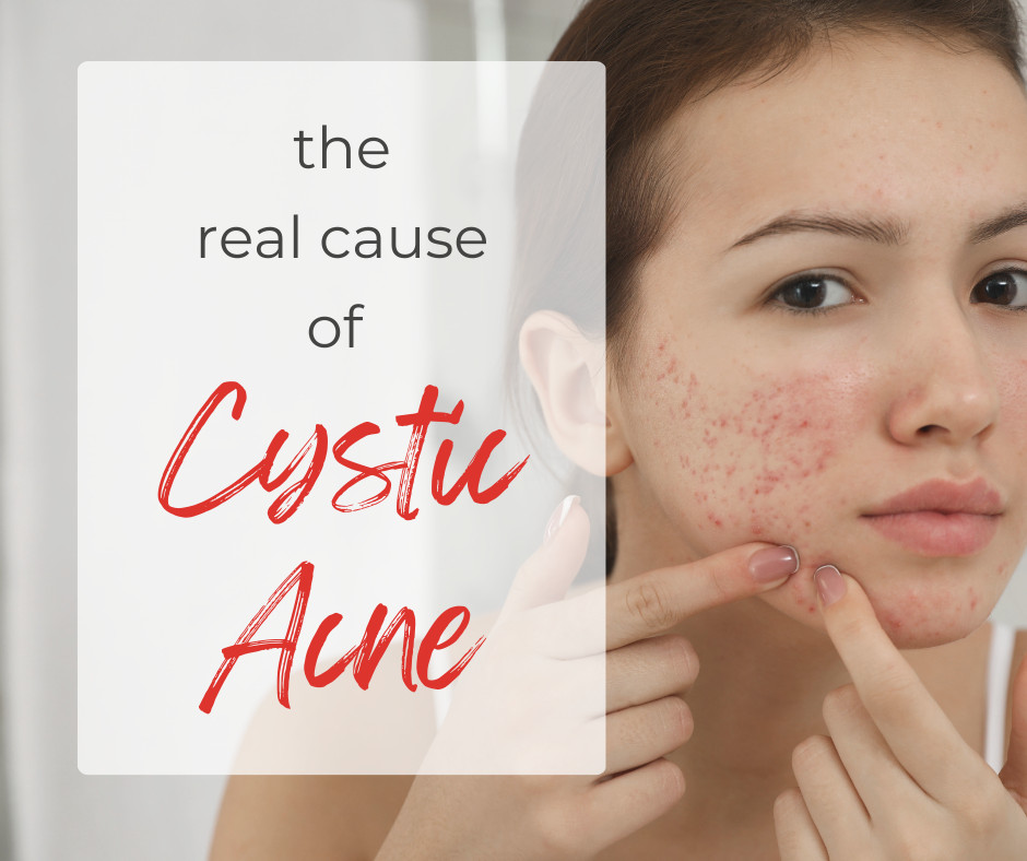 The Real Cause of Cystic Acne