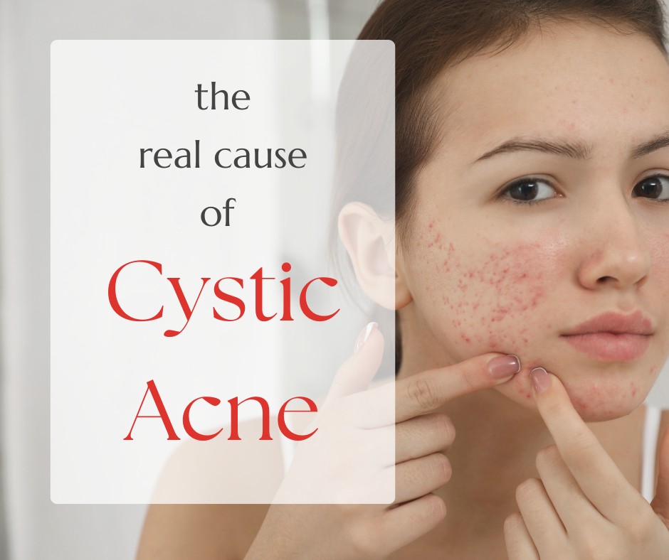 The Real Cause of Cystic Acne