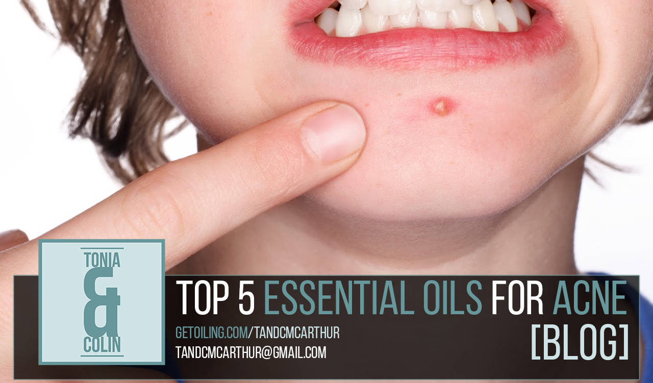 Top 5 Essential Oils for Acne