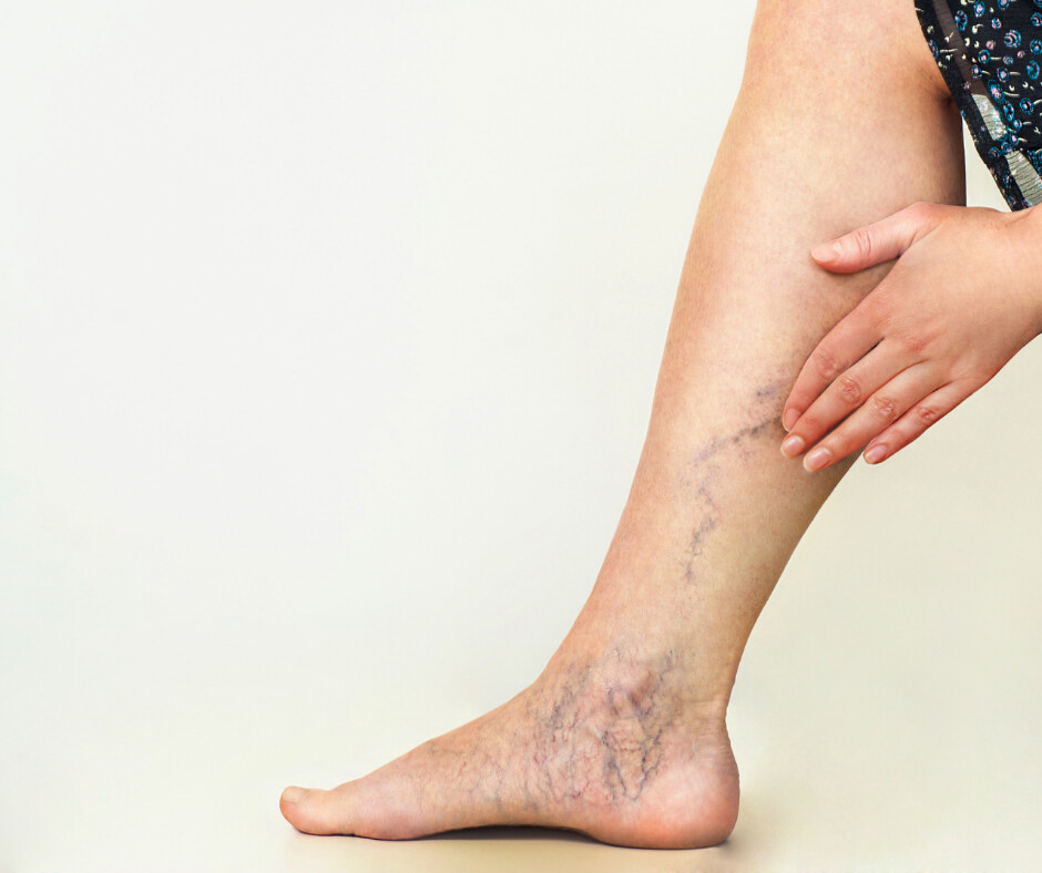 Varicose Veins Support