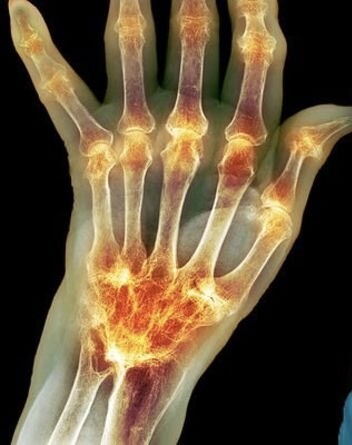 5 causes of arthritis