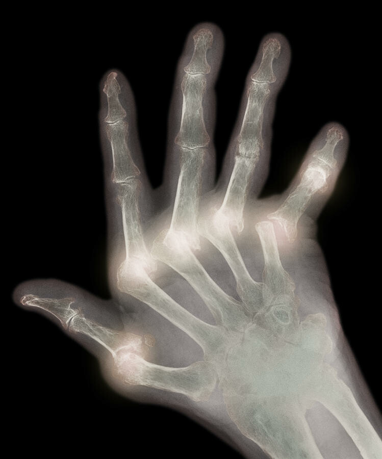 Can arthritis be seen on an x-ray?