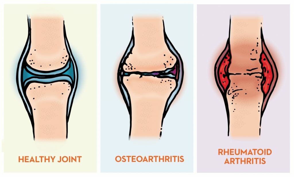 What’s the Difference between Arthritis and Osteoarthritis?