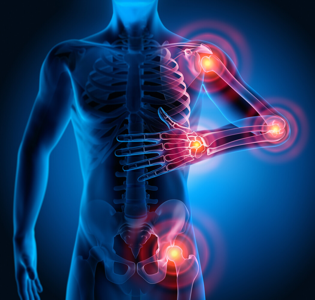 What is the difference between Arthritis and Rheumatoid arthritis?