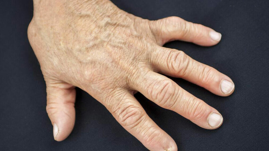 What is stage 1 rheumatoid arthritis?