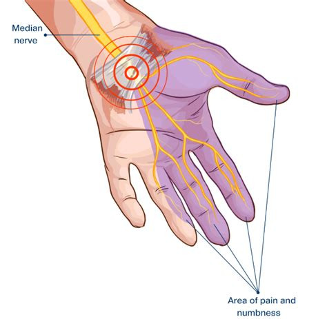 Does arthritis cause Carpel Tunnel Syndrome?