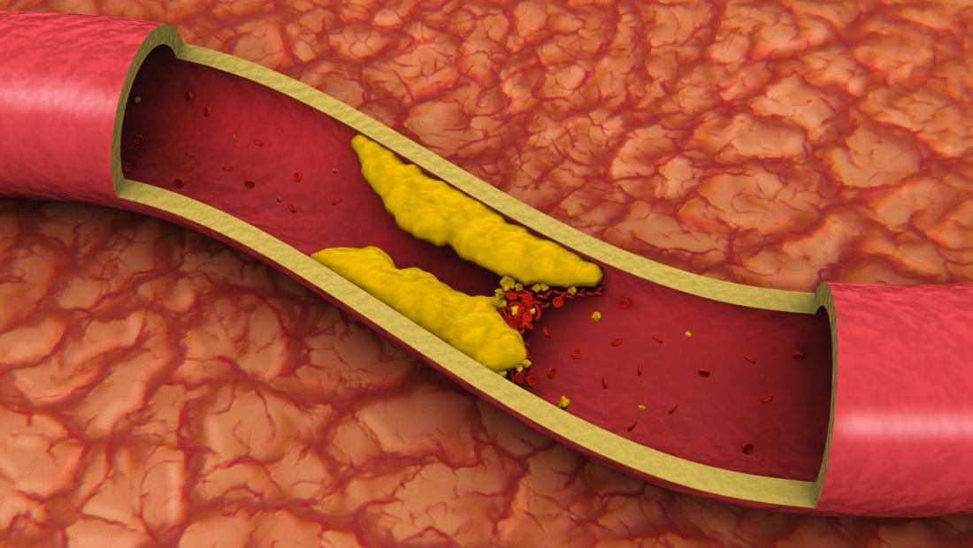 What does Coronary Heart Disease mean?