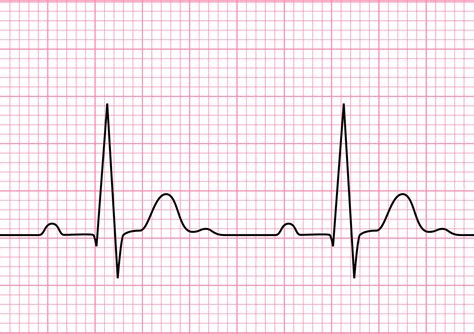 Can a ECG detect a blocked artery?