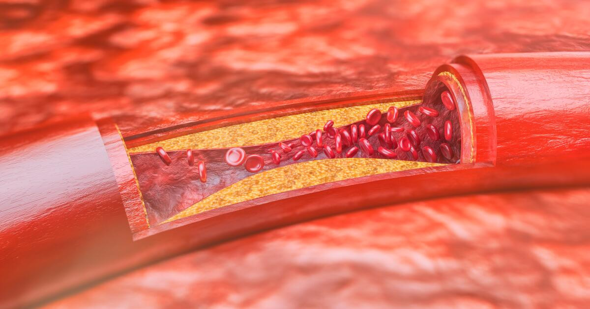 What are the stages of Coronary Heart Disease?