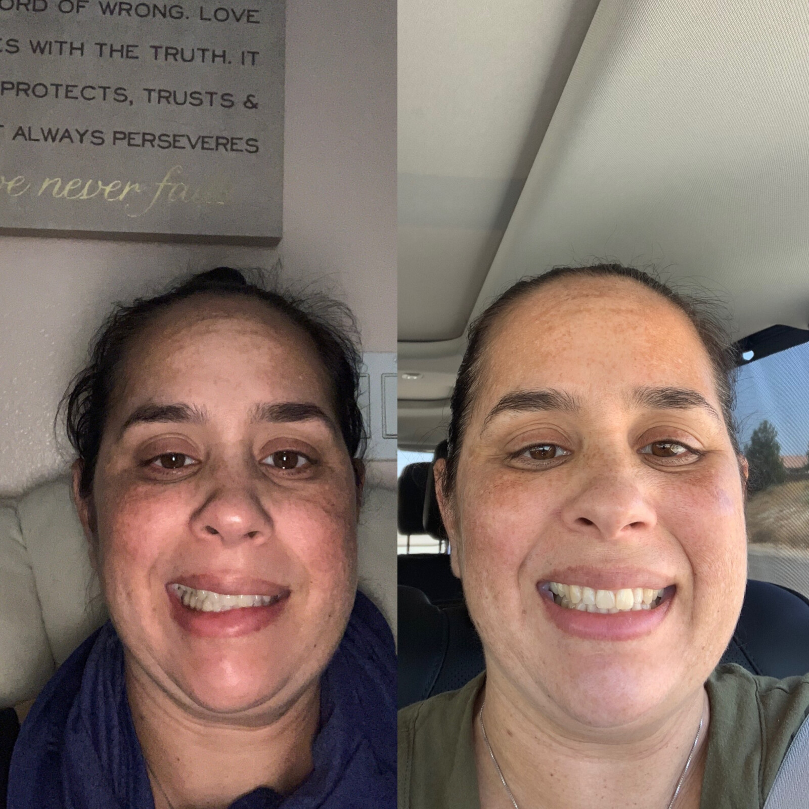 How I Recovered from Bells Palsy