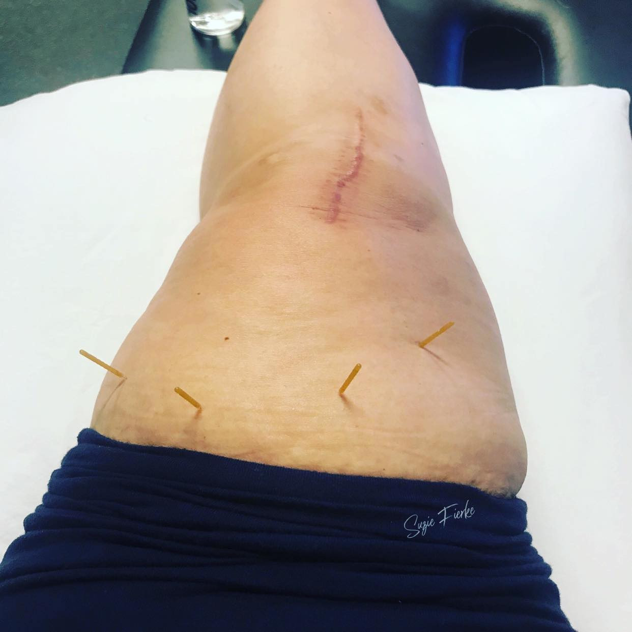 Poke the Pain Away – Dry Needling for Knee Replacement
