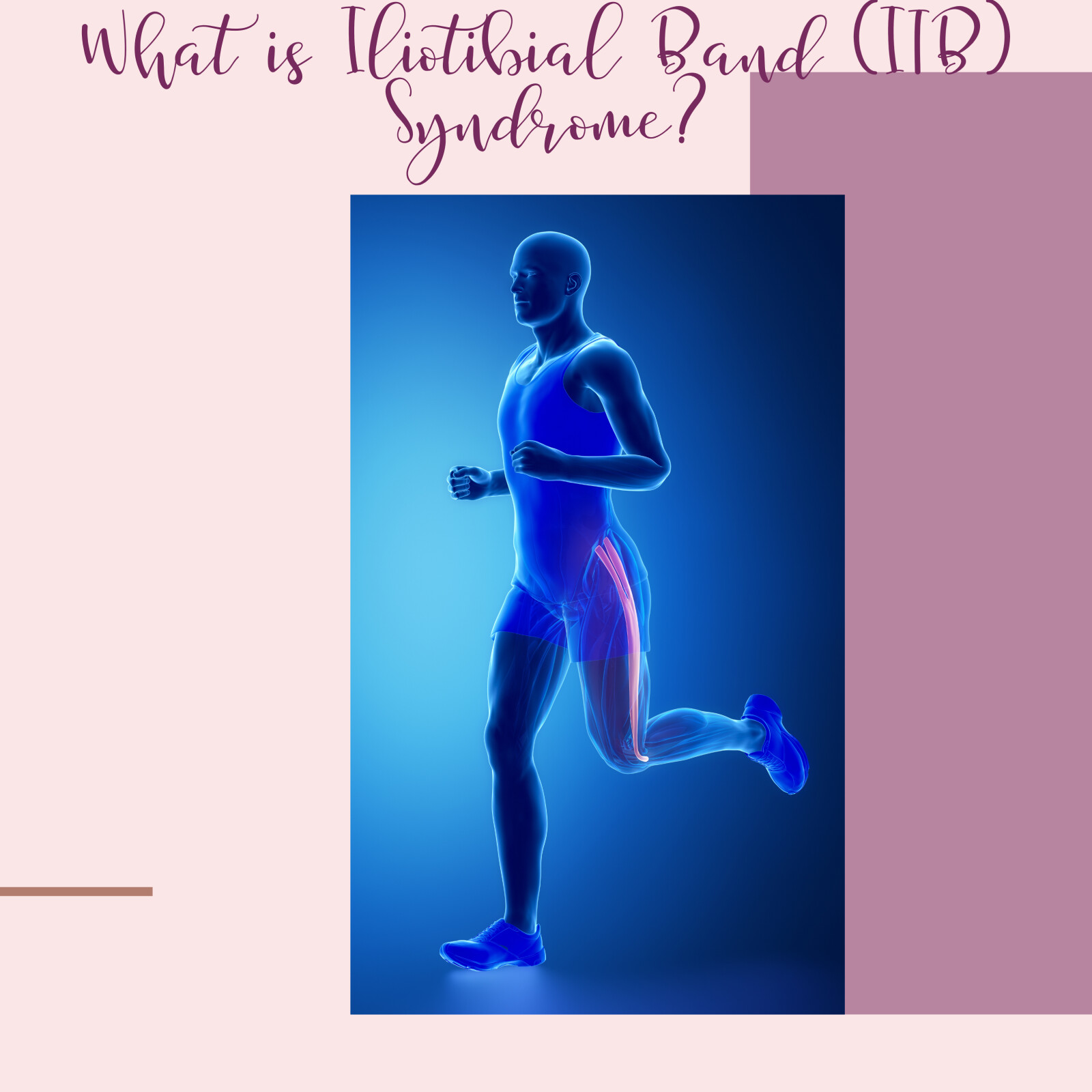 Outer thigh pain? It could be Iliotibial Band (ITB) Syndrome (Part 1