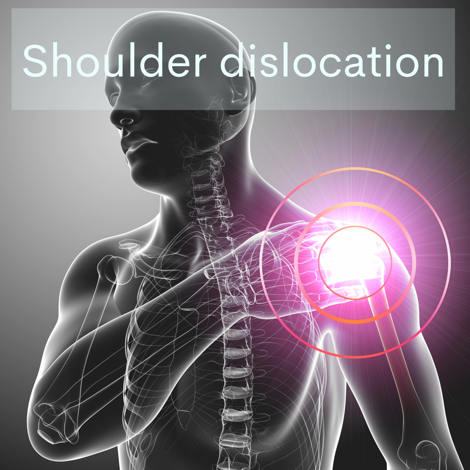 A simplified explanation of Shoulder Dislocations