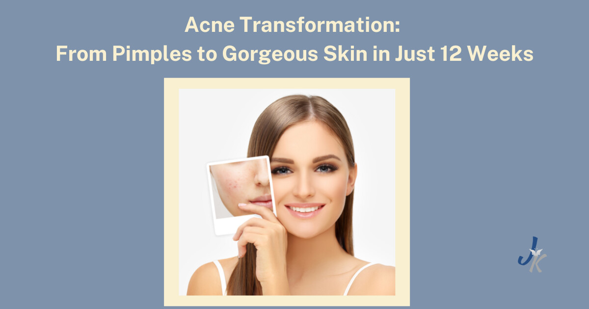 Acne Transformation: From Pimples to Gorgeous Skin in Just 12 Weeks