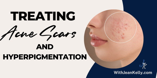 A Guide to Treating Acne Scars and Hyperpigmentation