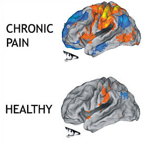 Understanding the Emotional-Physical Connection: How Emotions Correlate with Chronic Pain